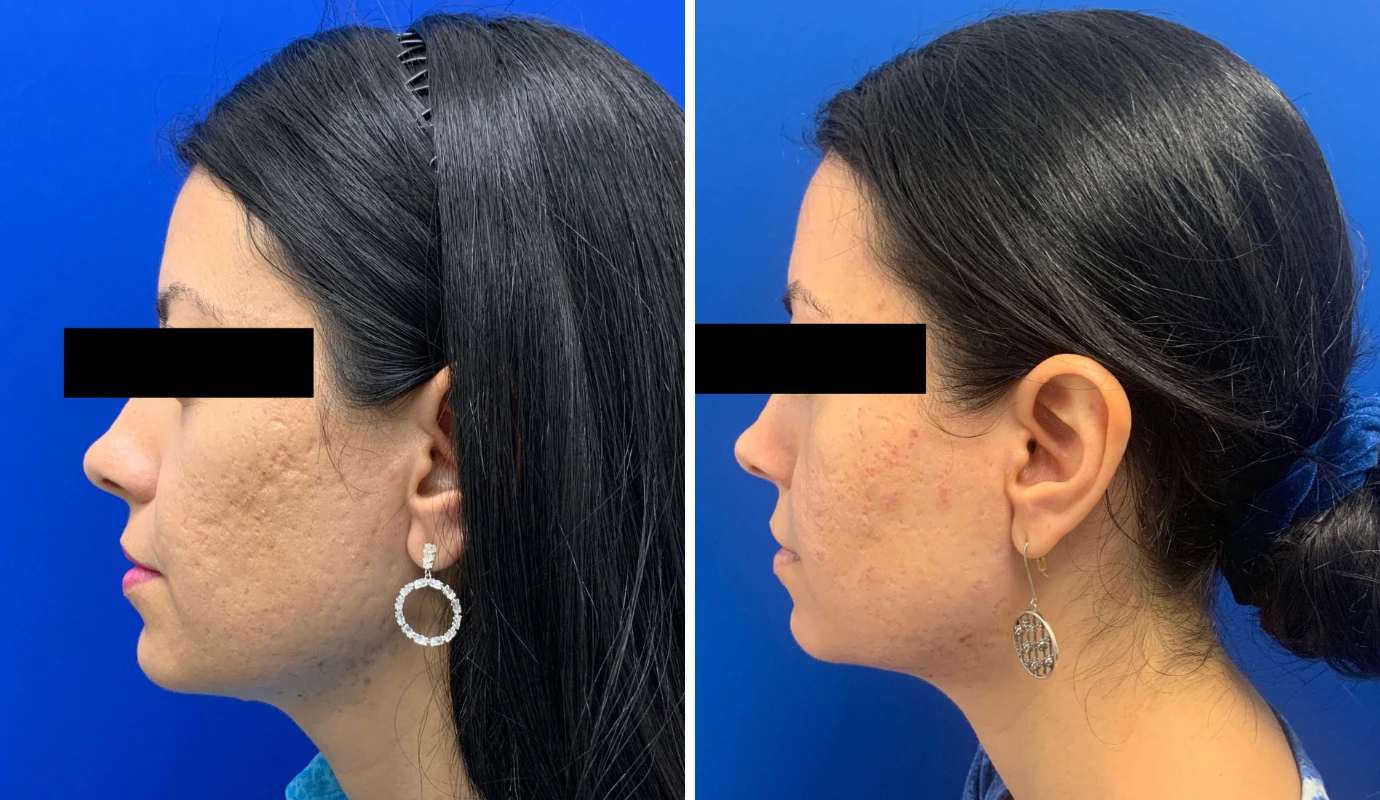 Before and after profile views of face showing skin texture improvement