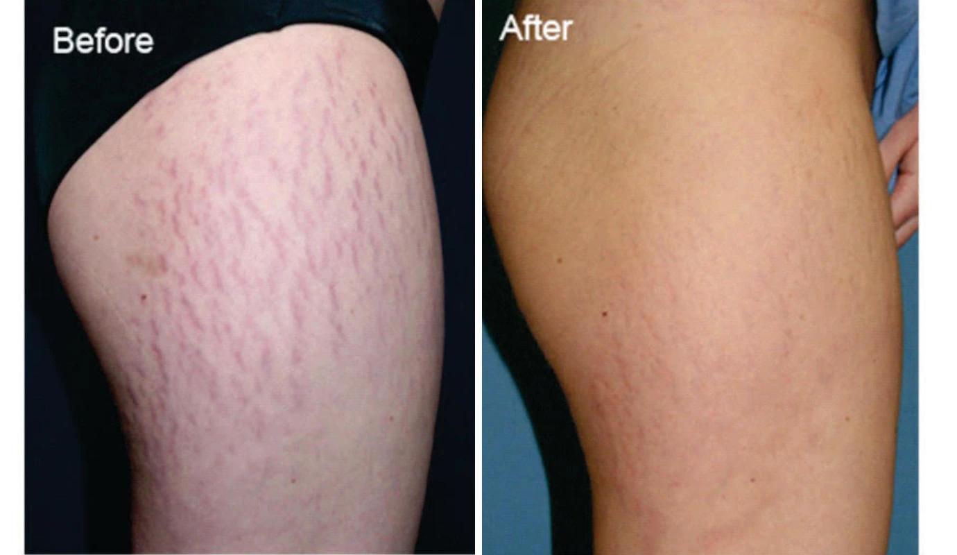 Before and after leg showing reduced stretch marks appearance
