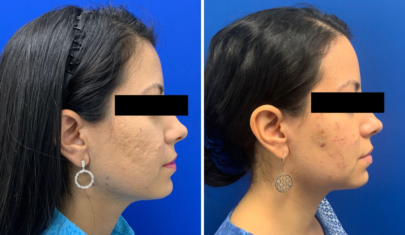 Before and after profile views showing facial contouring results