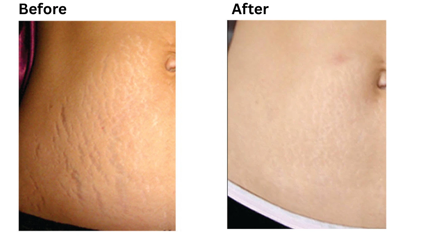 Before and after abdomen showing improved skin texture