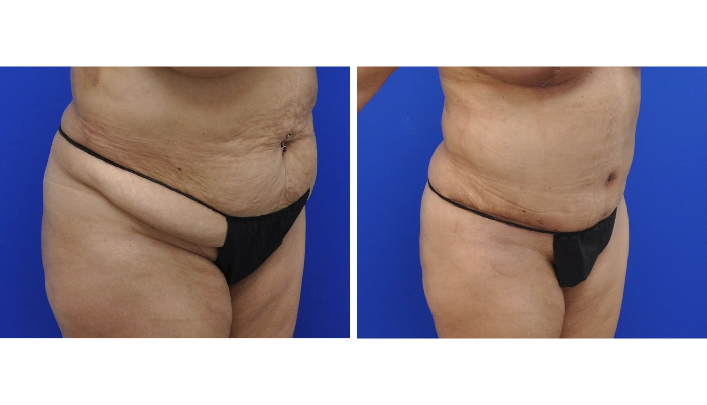 Before and after side-by-side comparison of liposuction results showing reduced abdominal and flank contours