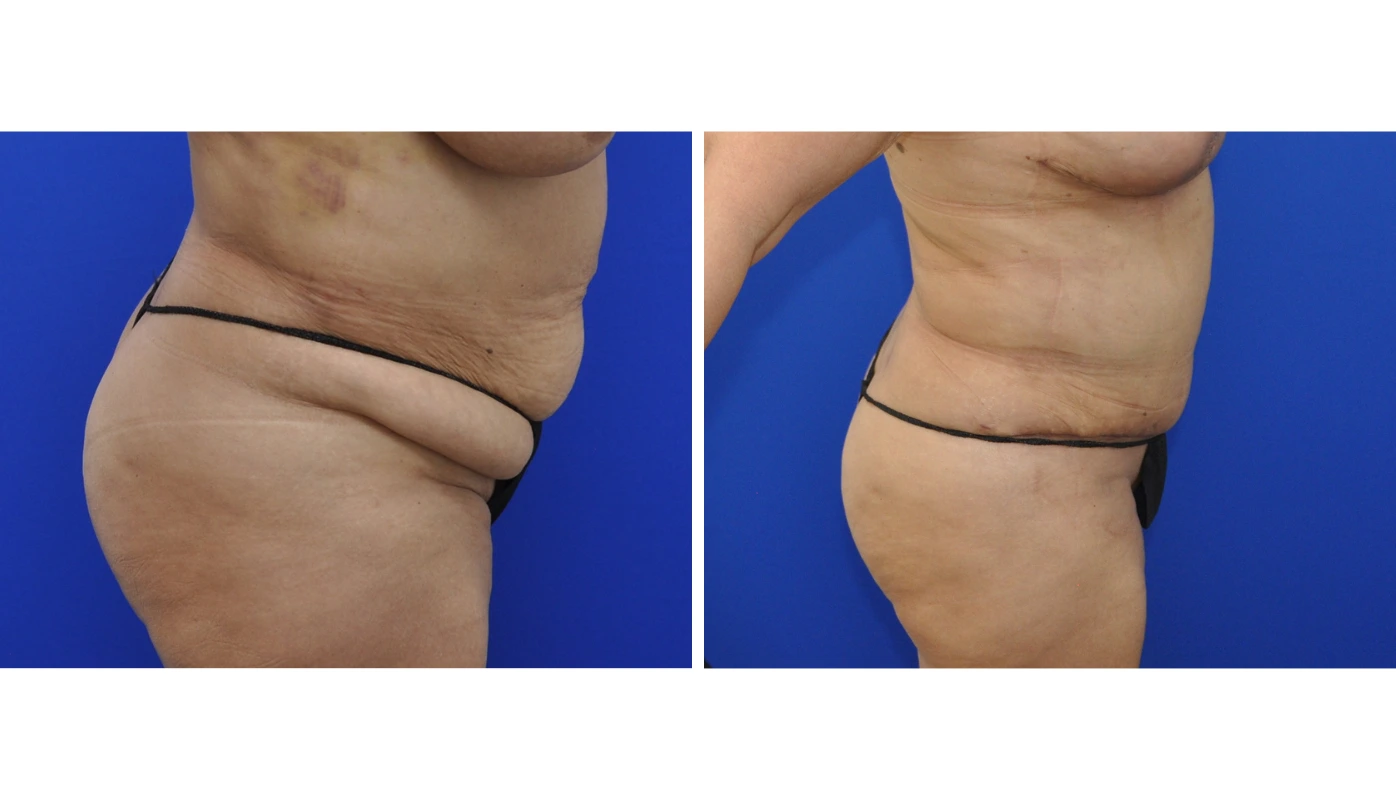 Before and after side profile comparison of body contouring showing improved waist and abdominal definition