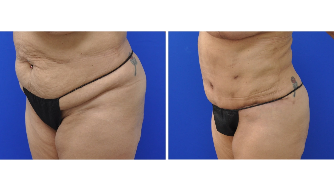 Before and after frontal comparison of liposuction results showing flattened abdomen and improved waistline