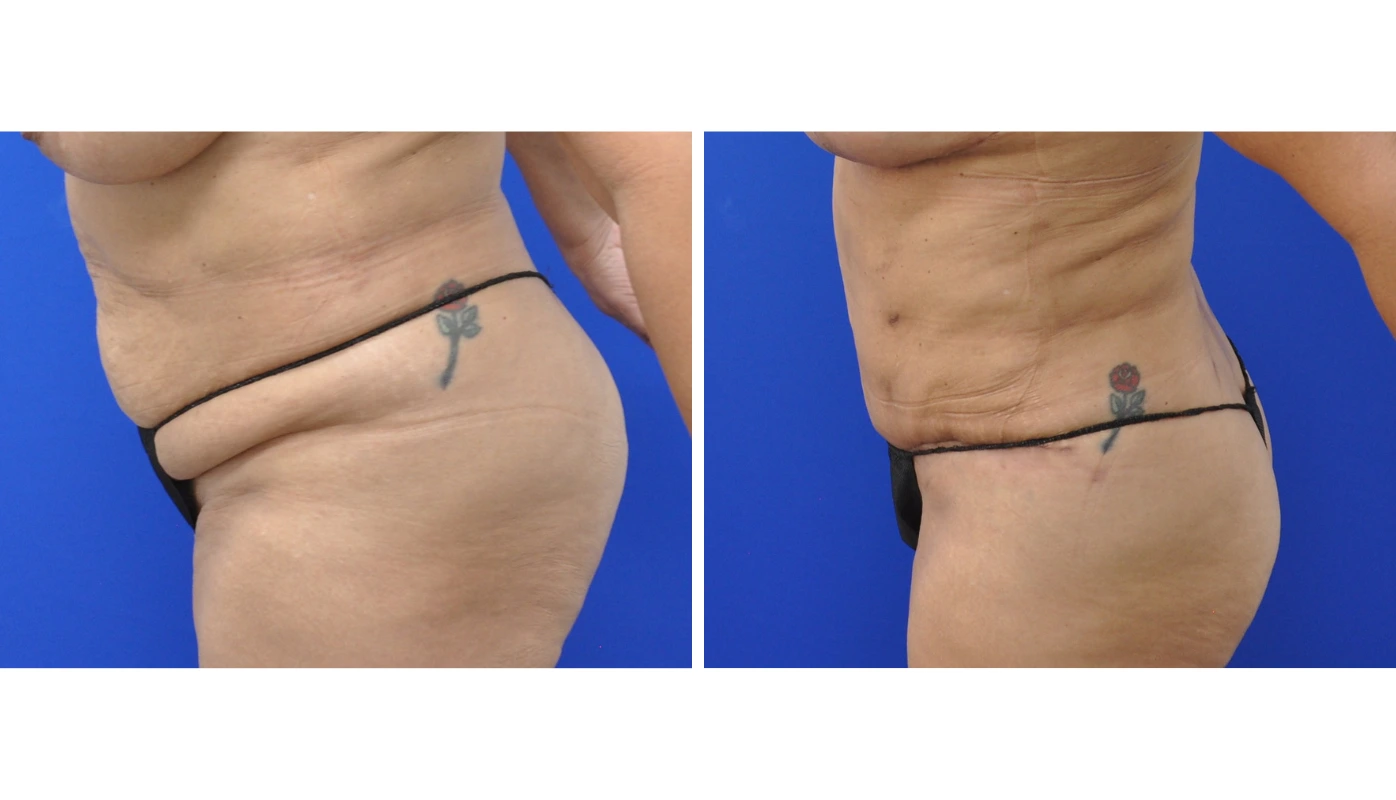 Before and after side-angle comparison of body contouring showing enhanced hip and waist proportions