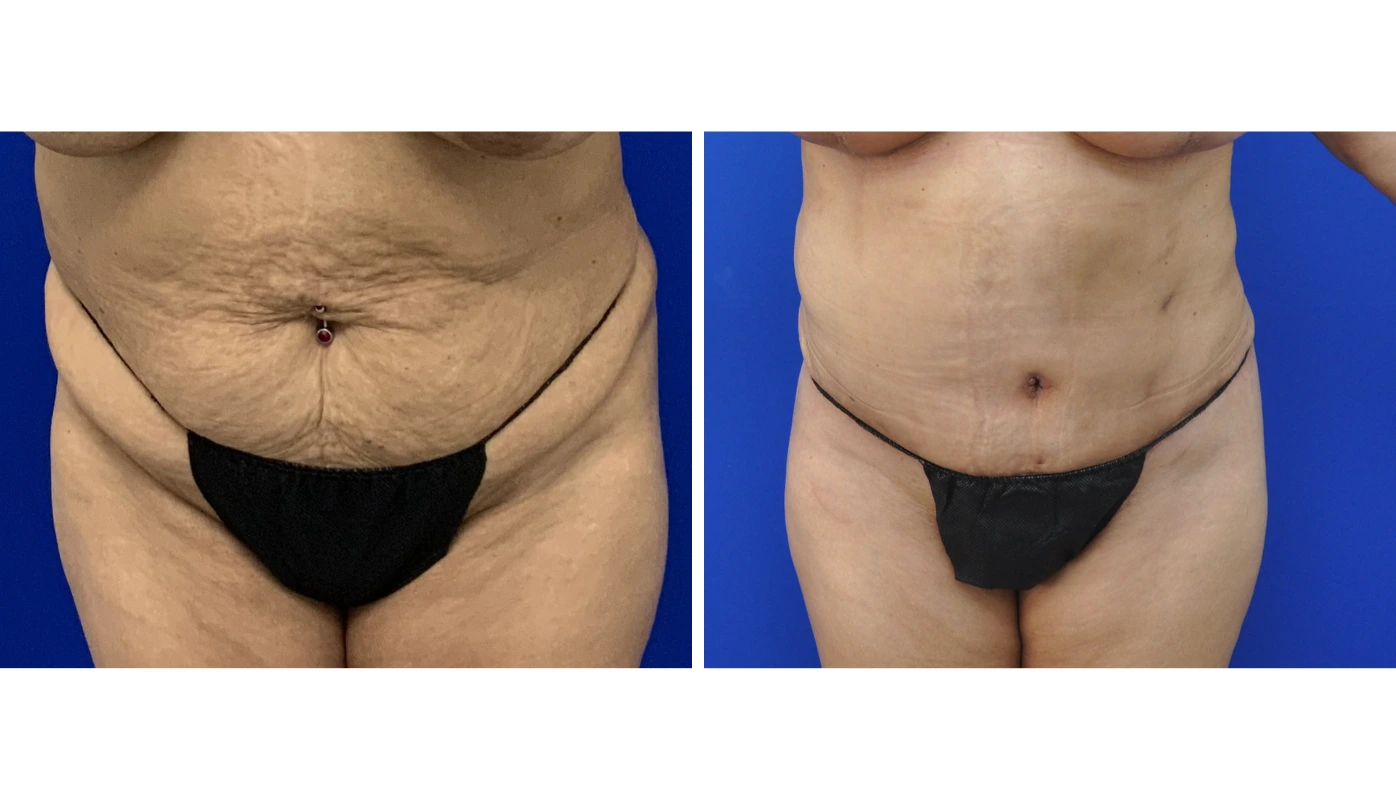 Before and after abdominoplasty showing reduced abdominal skin and improved contour
