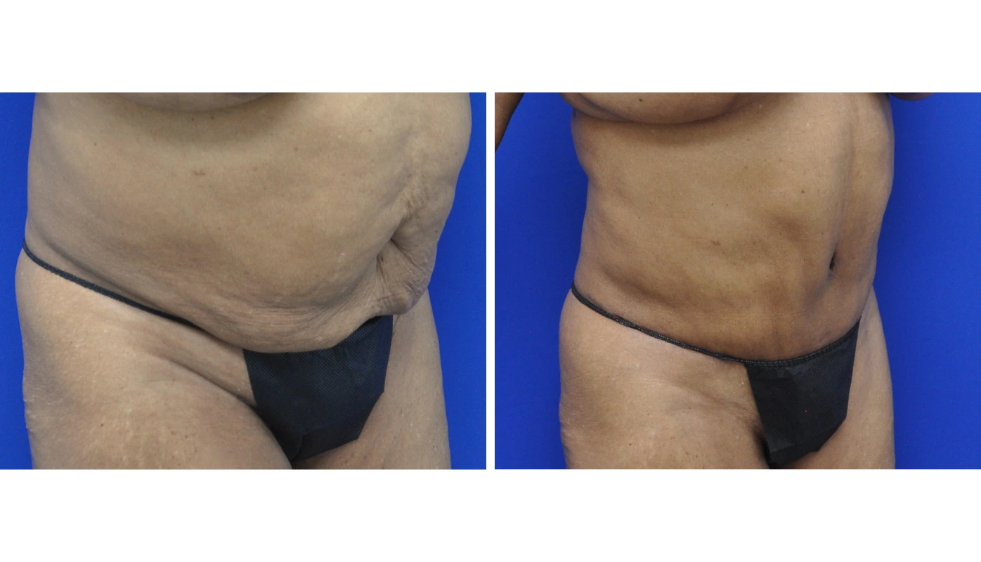 Before and after abdominal contouring, front view showing reduced skin laxity