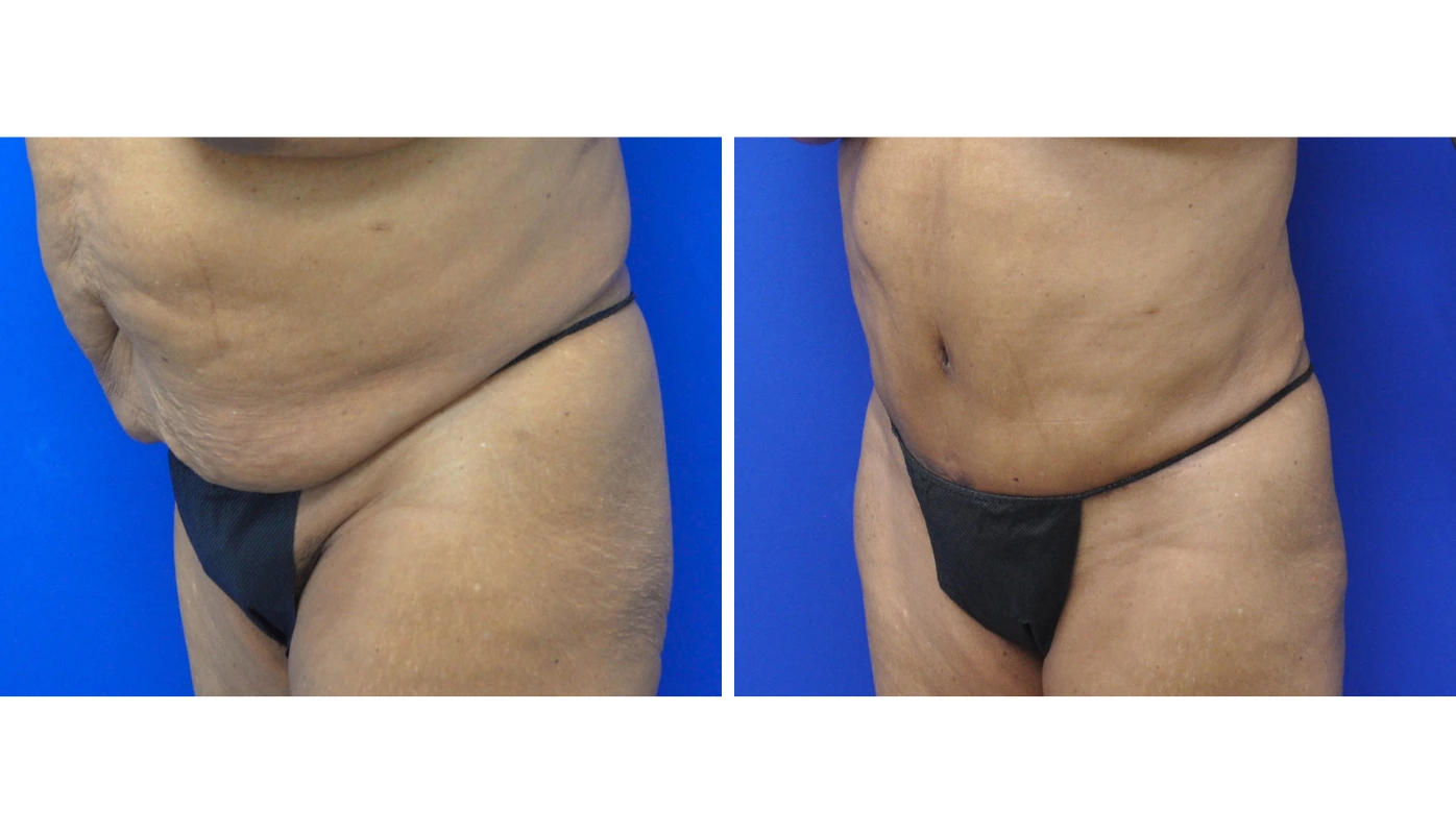 Before and after abdominal contouring, side view showing improved abdominal profile