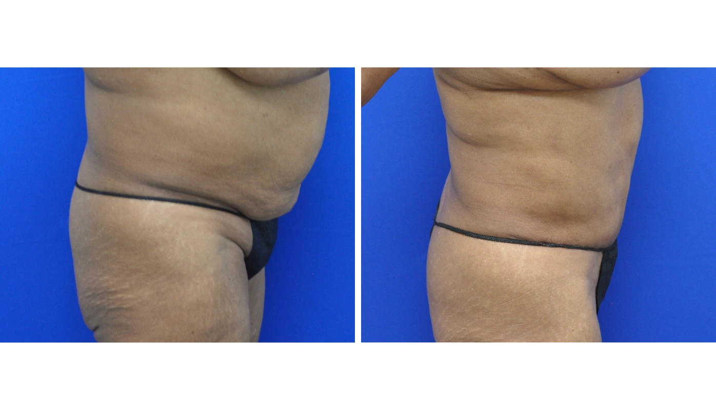 Before and after abdominal contouring, oblique view showing tightened midsection