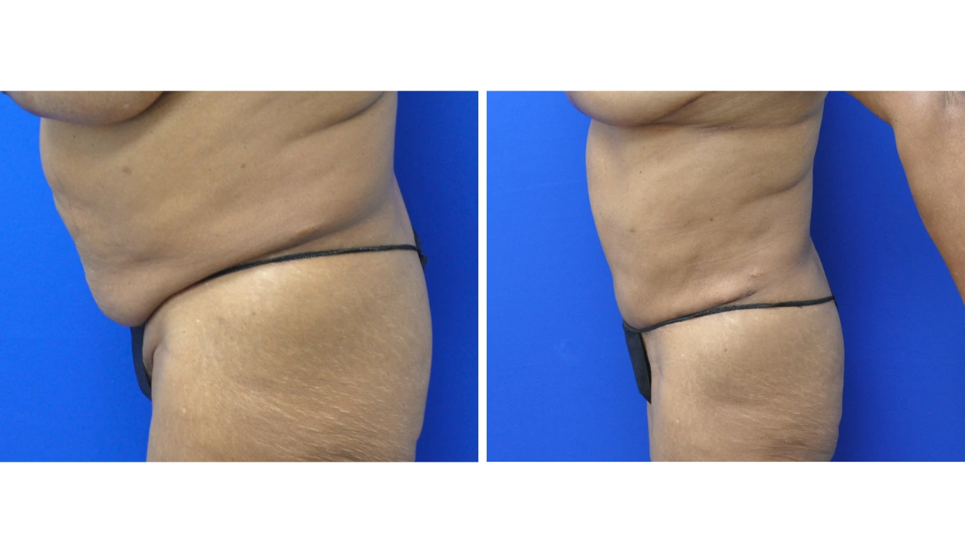 Before and after abdominal contouring, side view showing enhanced core definition