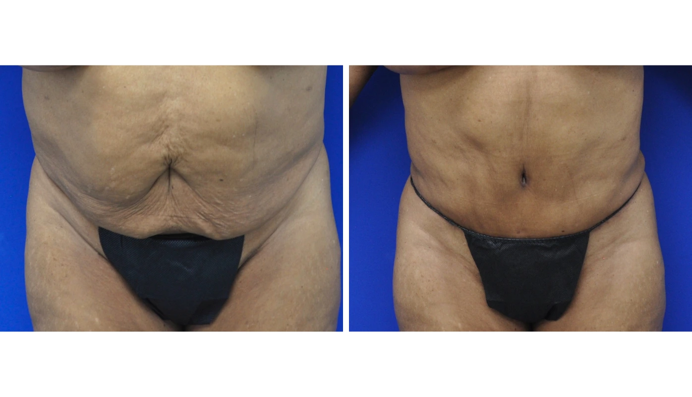 Before and after abdominal contouring, front view showing flatter abdomen