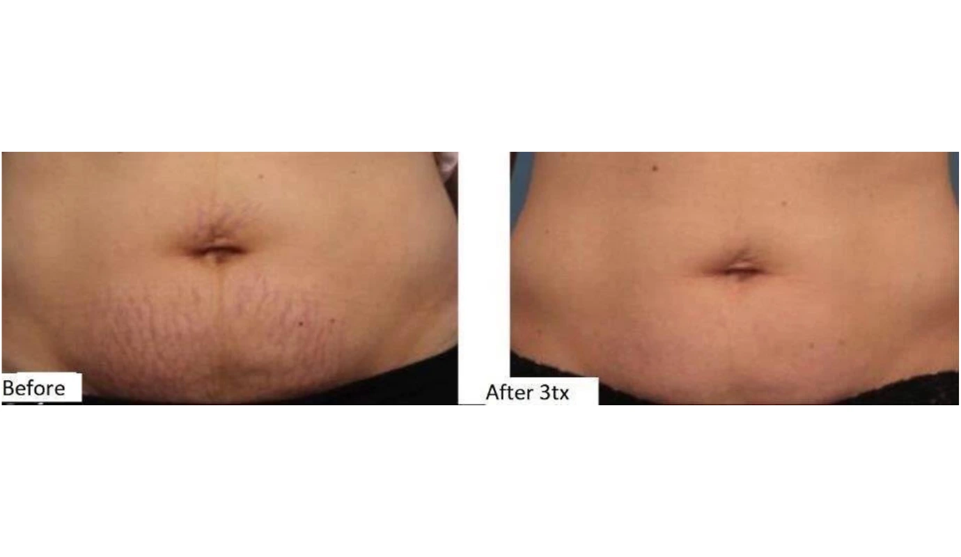 Before and after abdomen after 3 treatments showing reduced appearance of stretch marks