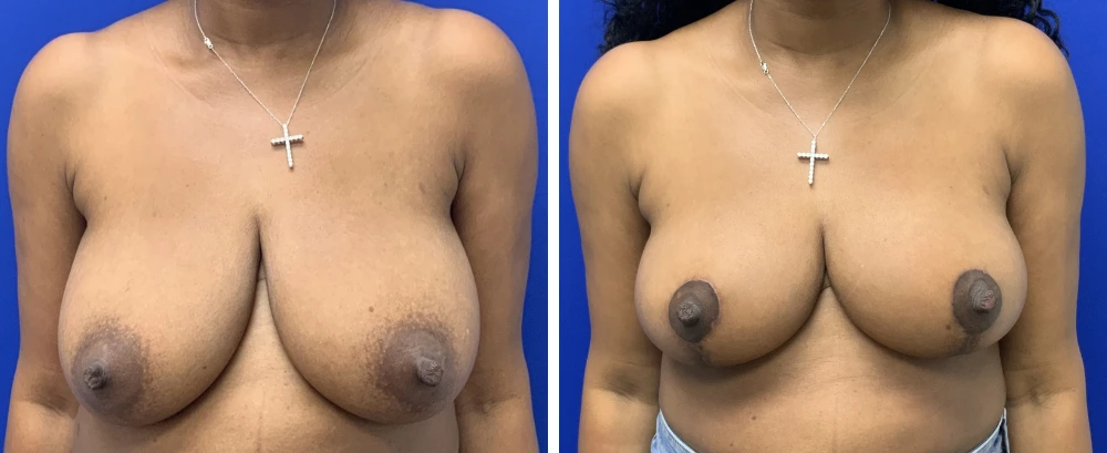 Breast reduction before and after frontal views