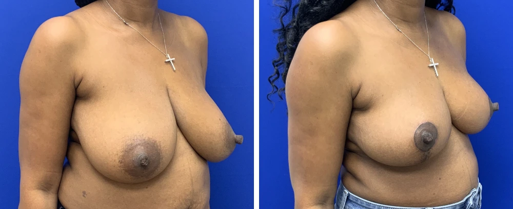 Breast reduction before and after oblique views