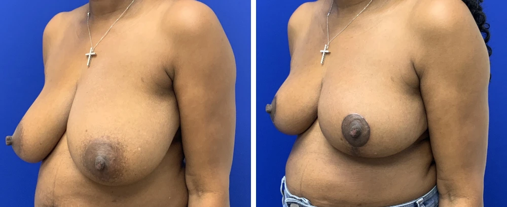 Breast reduction before and after three-quarter views
