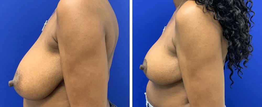 Breast reduction before and after side profile views