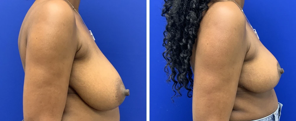 Breast reduction before and after side profile views