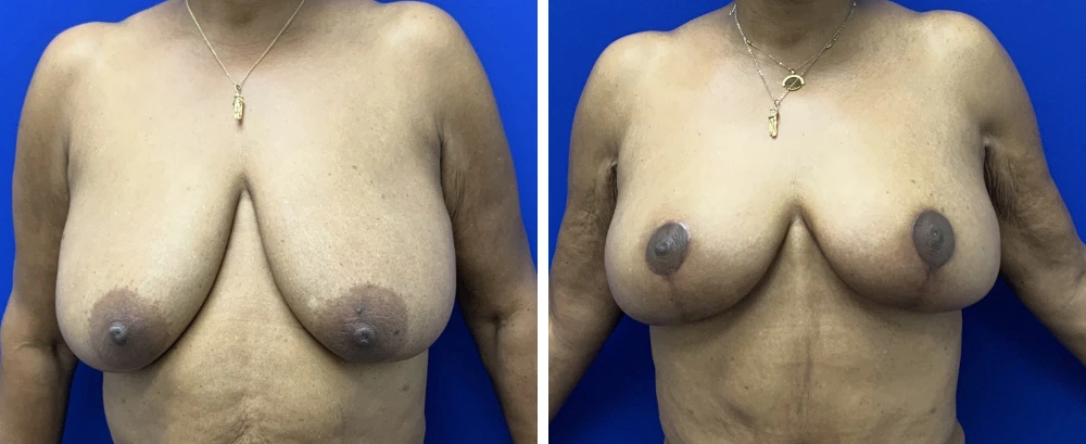 Breast reduction before and after, frontal view showing reduced volume and lifted contour