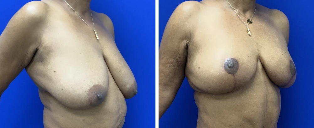 Breast reduction before and after, oblique views demonstrating decreased projection and improved shape