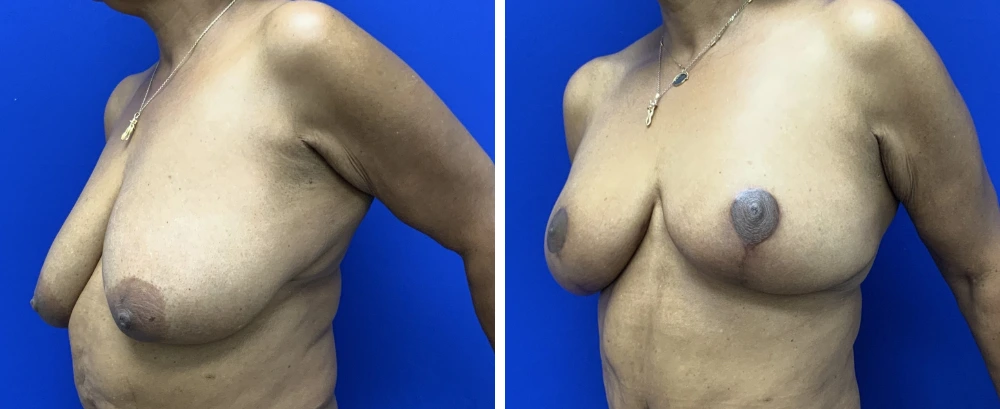 Breast reduction before and after, side and frontal views showing reduced breast size and perkier appearance