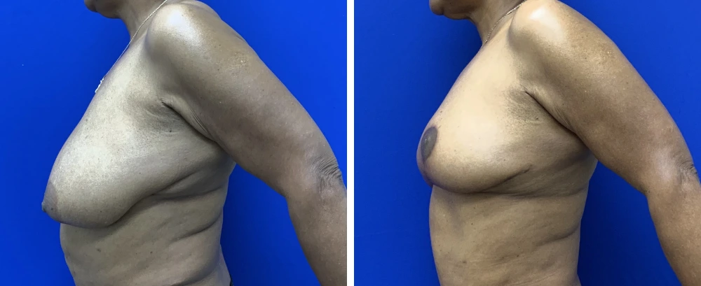 Breast reduction before and after, side profile views showing decreased forward projection and contour improvement