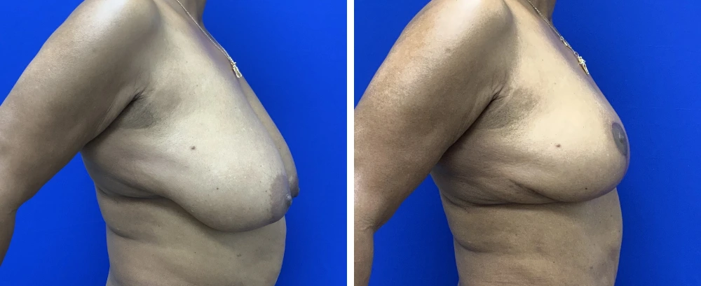 Breast reduction before and after, side profile close-up views demonstrating reduced volume and refined shape