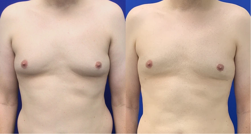 Male chest before and after gynecomastia treatment, front view showing flattened contour