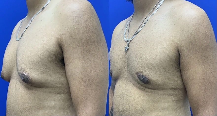Male chest before and after gynecomastia treatment, side view showing improved chest definition