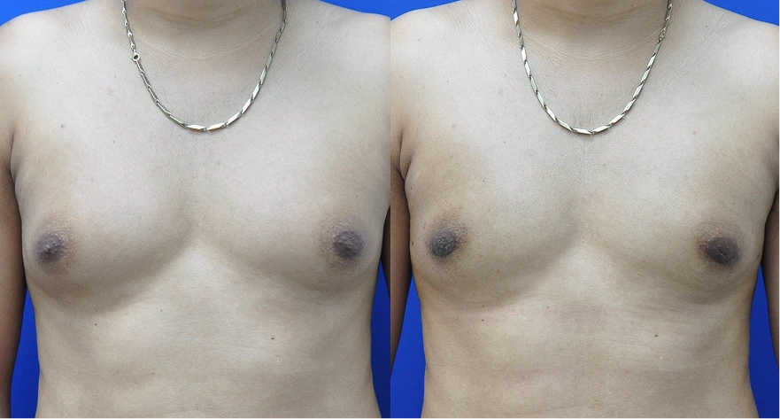 Male chest before and after gynecomastia treatment, front view showing reduced breast fullness