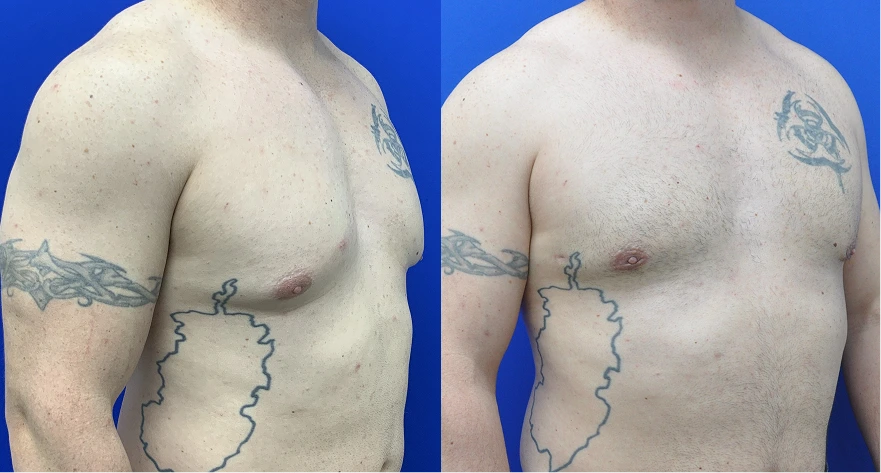 Male chest before and after gynecomastia treatment, side view with surgical markings showing results