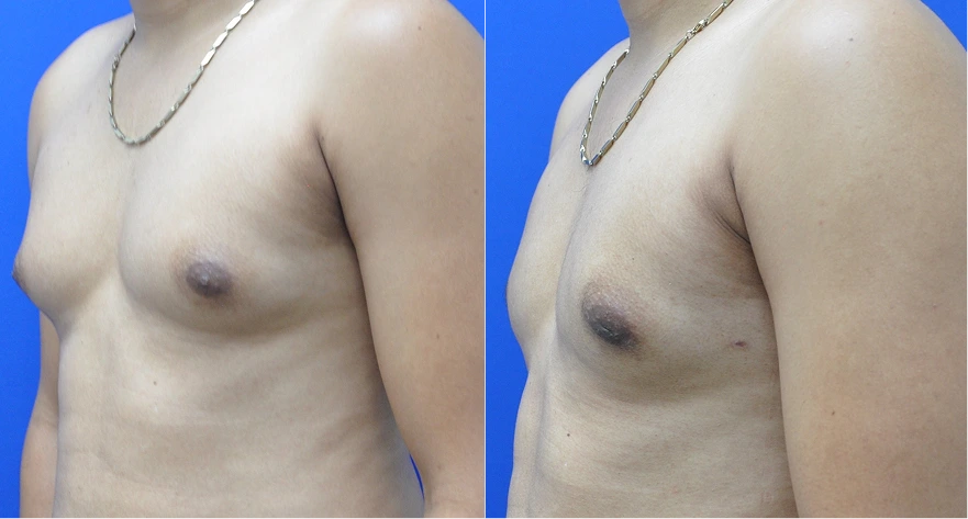 Male chest before and after gynecomastia treatment, side view showing contour improvement