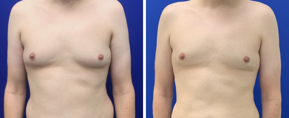 Gynecomastia case 10 before and after surgery, front view showing chest reduction