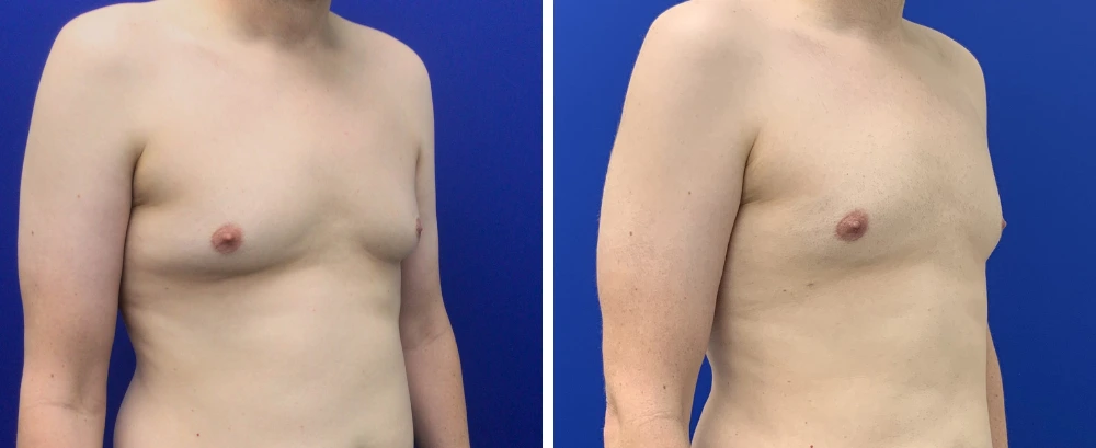 Gynecomastia case 10 before and after surgery, side view showing chest contouring