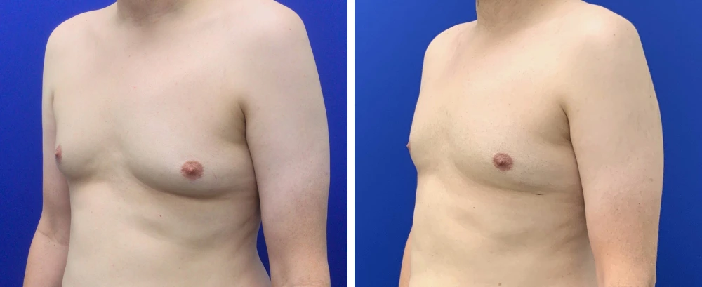 Gynecomastia case 10 before and after surgery, oblique view showing profile change