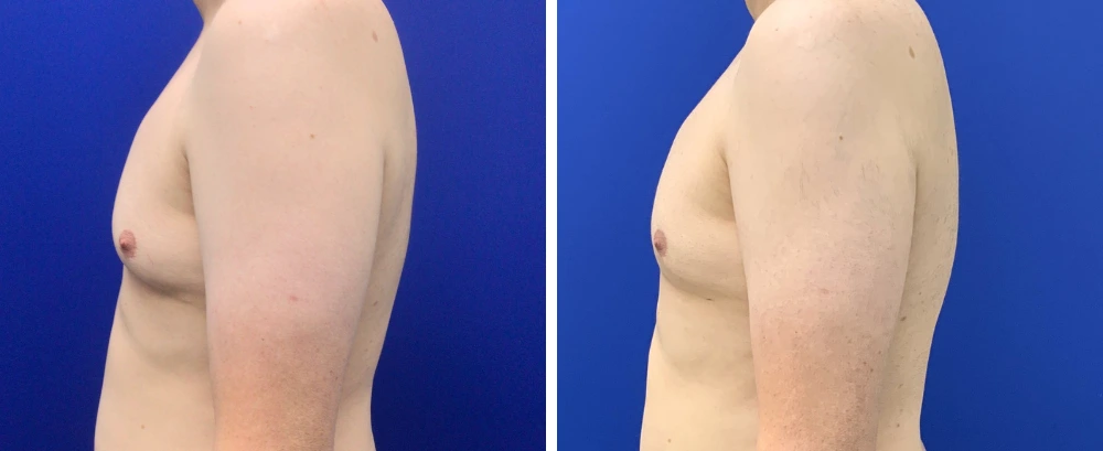 Gynecomastia Case 10 before and after side profile showing chest contour improvement