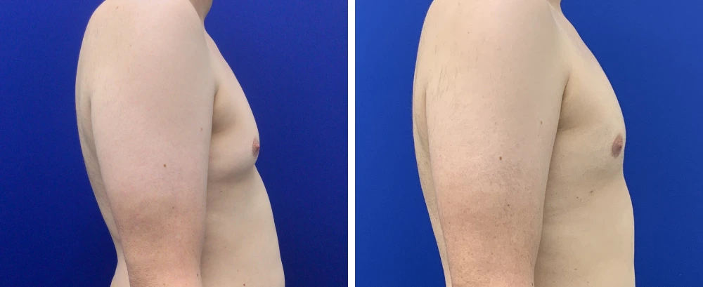 Gynecomastia Case 10 before and after oblique view demonstrating surgical results