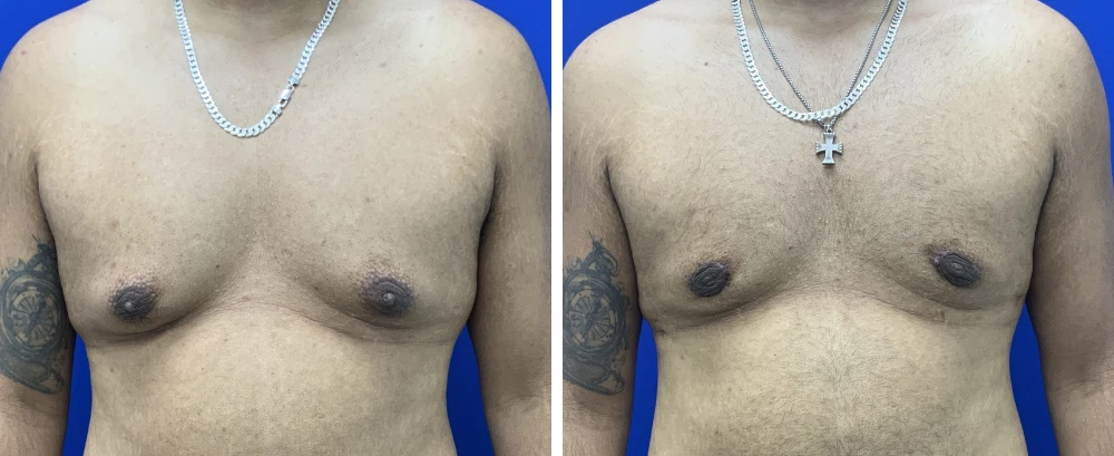 Gynecomastia Case 11 before and after front view showing chest definition improvement