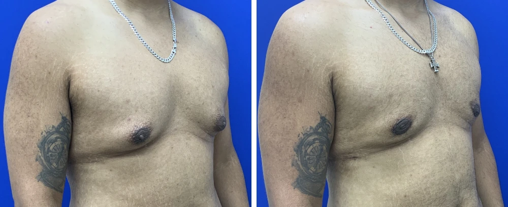 Gynecomastia Case 11 before and after oblique front view of chest contour