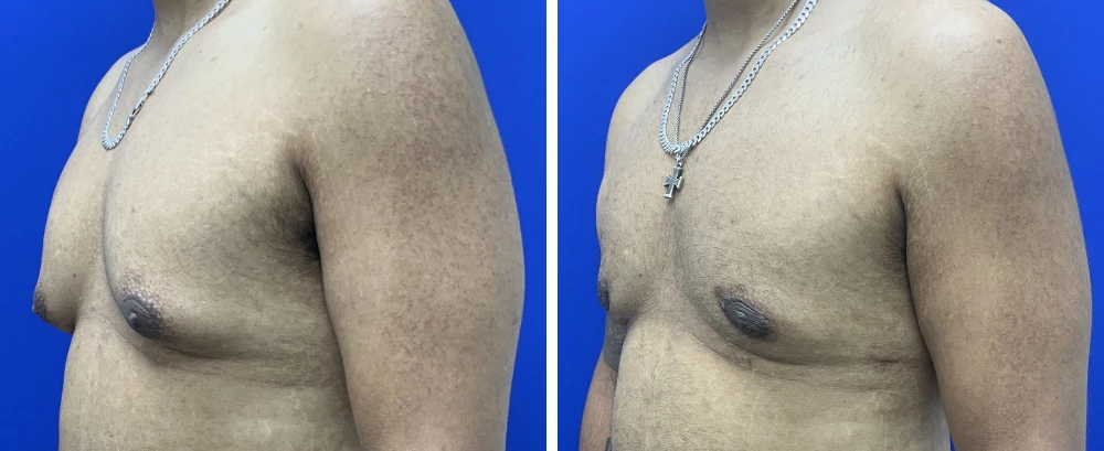 Gynecomastia Case 11 before and after side profile showing chest flatness