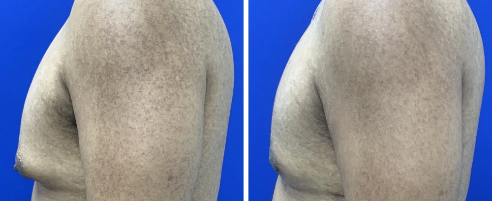 Gynecomastia Case 11 before and after back view showing overall body contour