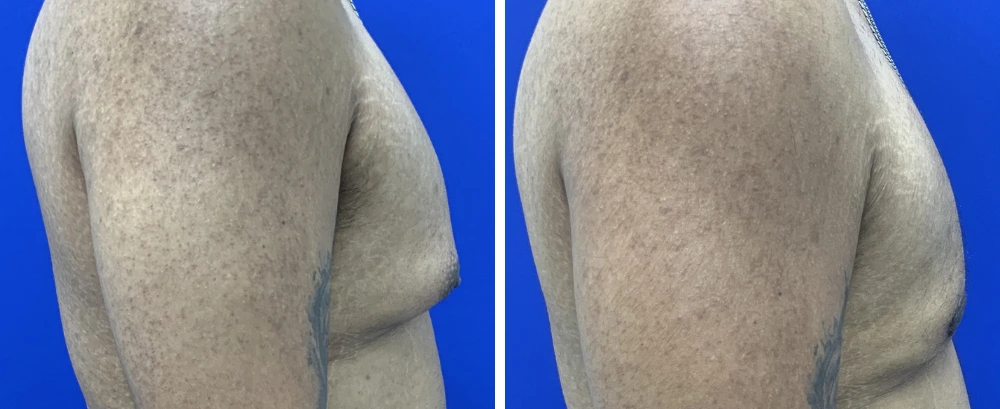 Before and after gynecomastia surgery, patient shown from side view against blue background