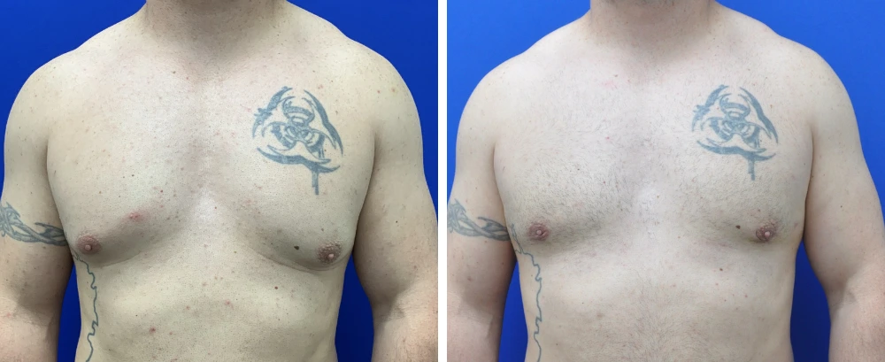 Gynecomastia surgery before and after, frontal view showing reduced breast tissue and flatter chest contour