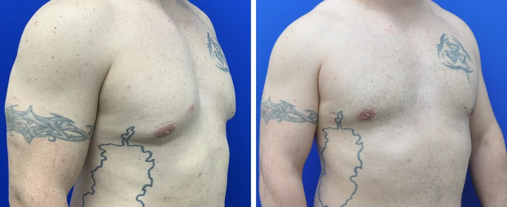 Before and after gynecomastia case 8, angled front view showing chest contour reduction