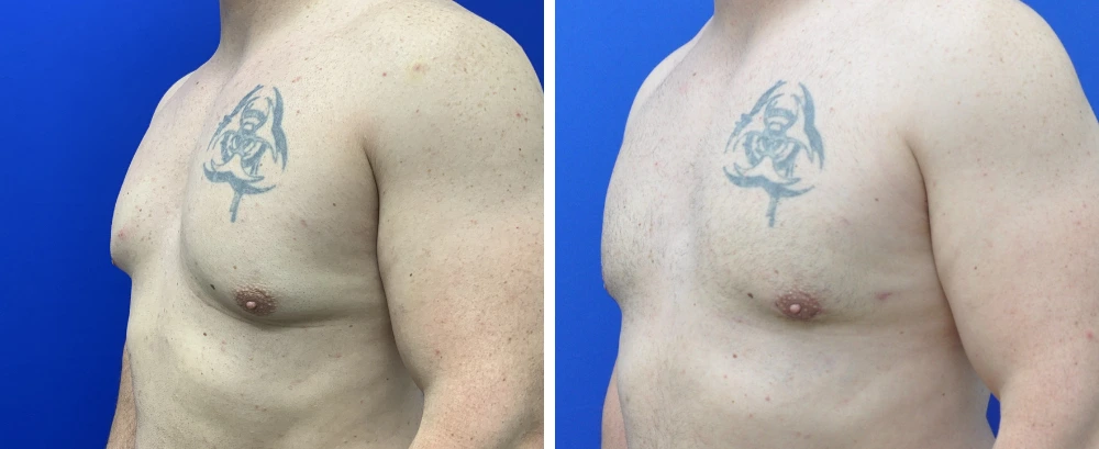 Before and after gynecomastia case 8, side view showing profile chest changes