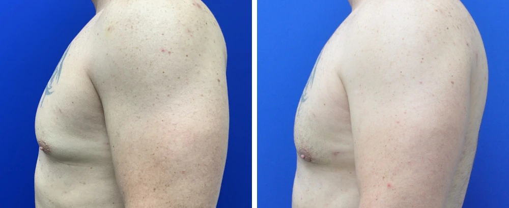 Before and after gynecomastia case 8, side profile view of chest from different angle