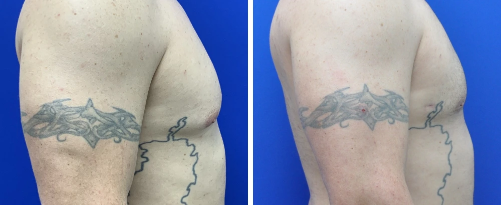 Before and after gynecomastia case 8, angled side view with surgical markings