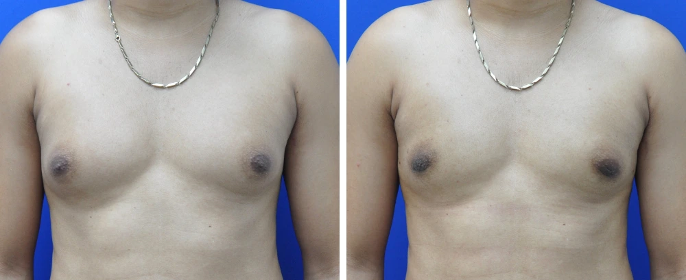 Before and after gynecomastia case 9, front view showing chest symmetry improvement