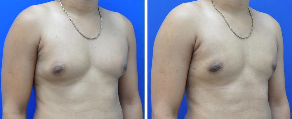 Before and after gynecomastia case 9, angled front view showing chest contour refinement