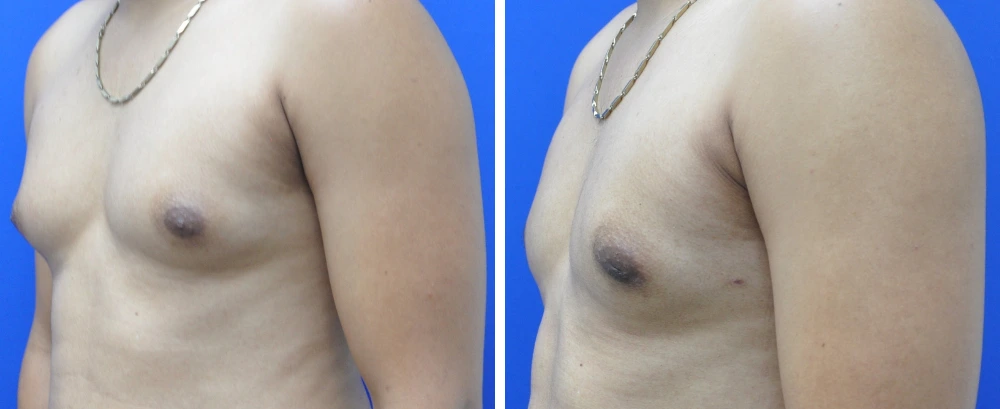 Gynecomastia case 9 before and after surgery, front view showing chest reduction