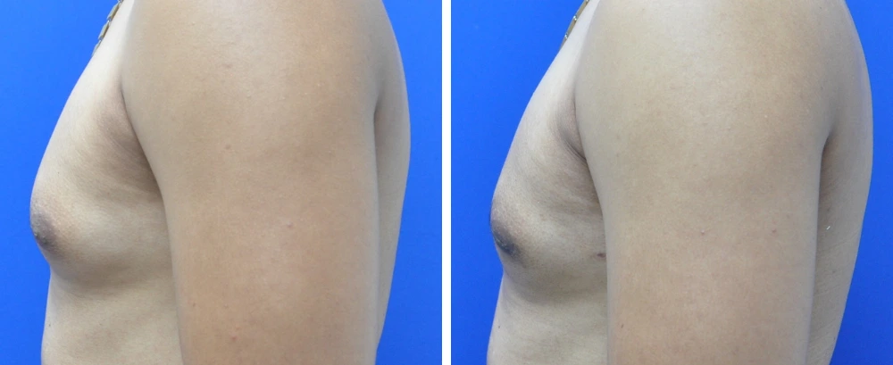 Gynecomastia case 9 before and after surgery, side view showing chest contouring