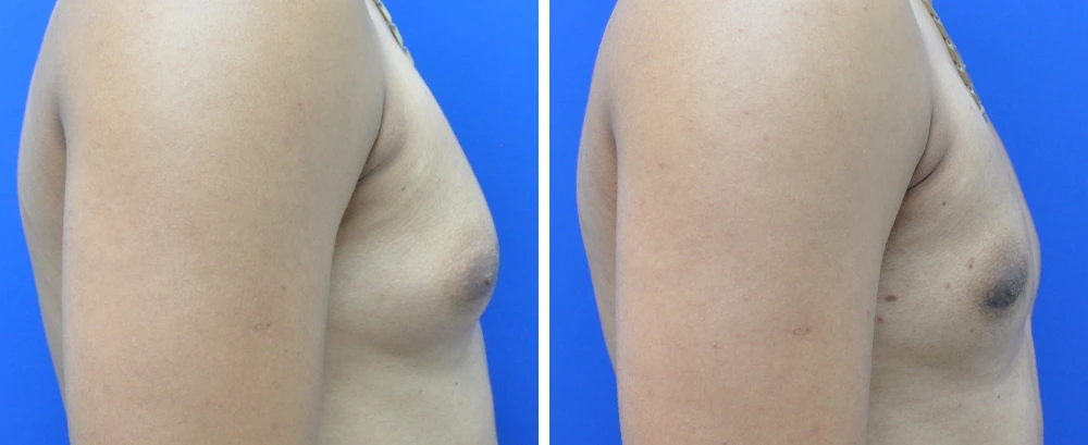 Gynecomastia case 9 before and after surgery, oblique view showing profile change